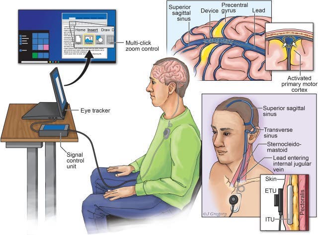  El dispositivo Stentrode de Synchron permite la comunicación directa entre un cerebro humano y una computadora, sin necesidad de teclear o hablar
(Journal of Neurointerventional Surgery)