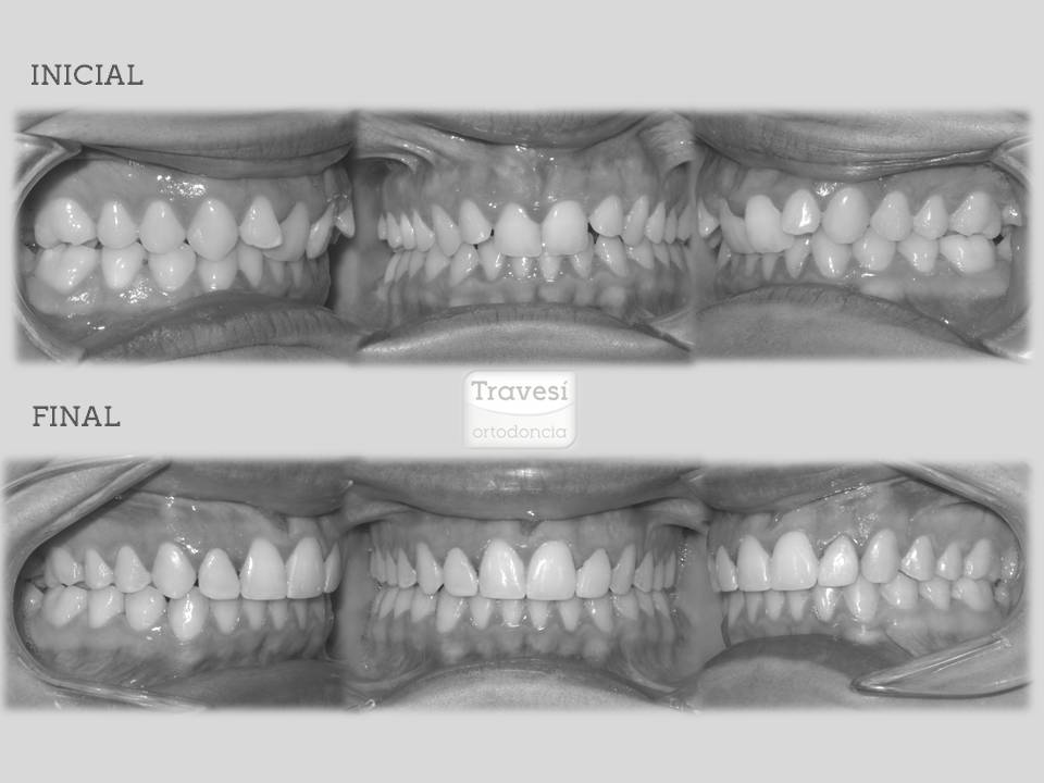 Inicio y final de algunos tratamientos con ortodoncia invisible / Travesí Ortodoncia 