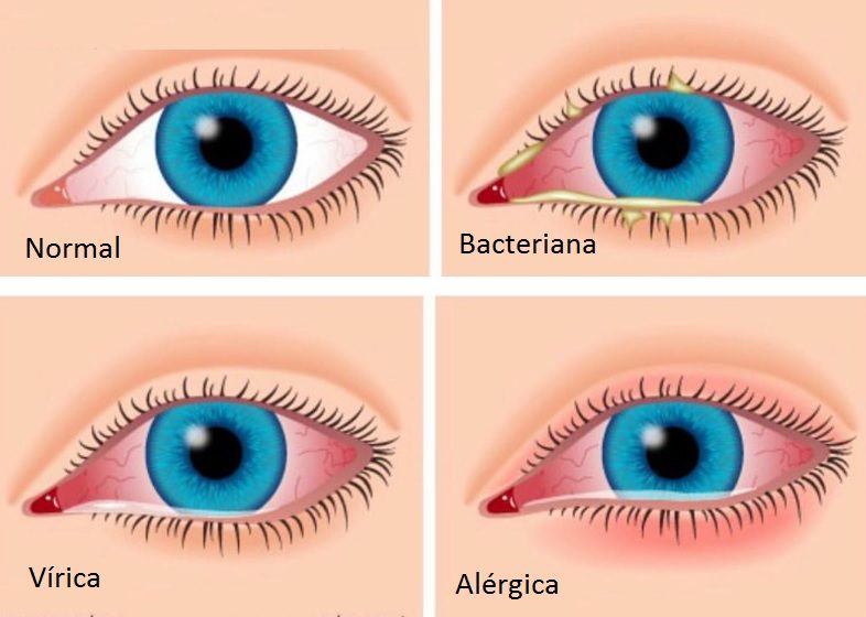 Tipos de conjuntivitis / Óptica Santa Faz