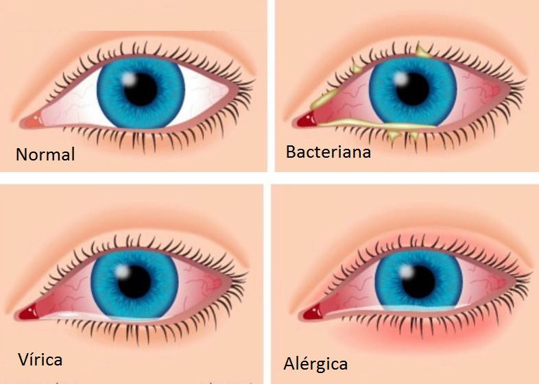 Tipos de conjuntivitis / Óptica Santa Faz