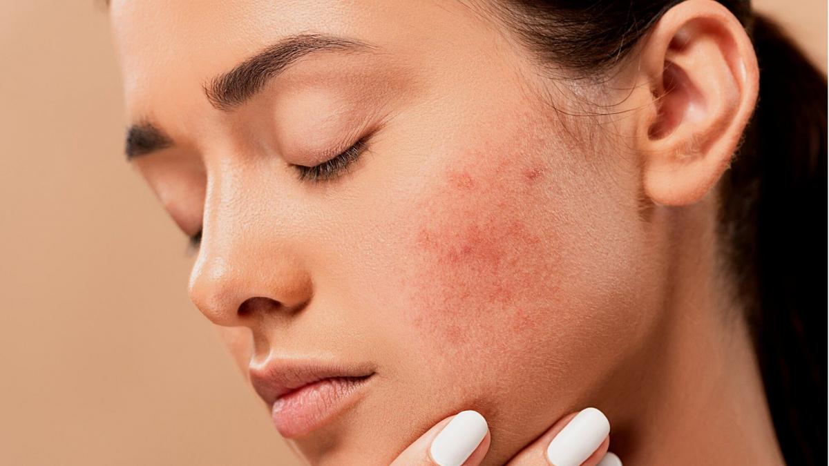 Los expertos en dermatología del Hospital Clínico San Carlos alertan sobre las enfermedades más consultados / 20 Minutos