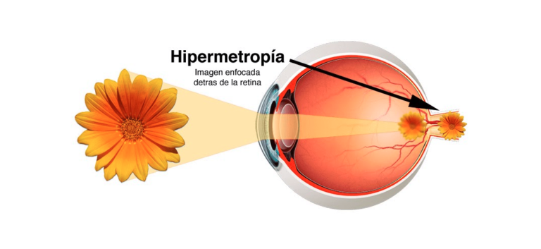 Explicación de la hipermetropía