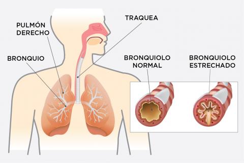 Enfermedad Pulmonar Obstructiva Crónica / Bupasalud.com