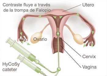 La histeriosalpingografía se realiza en mujeres con dificultades para quedarse embarazadas / Madre Solterona