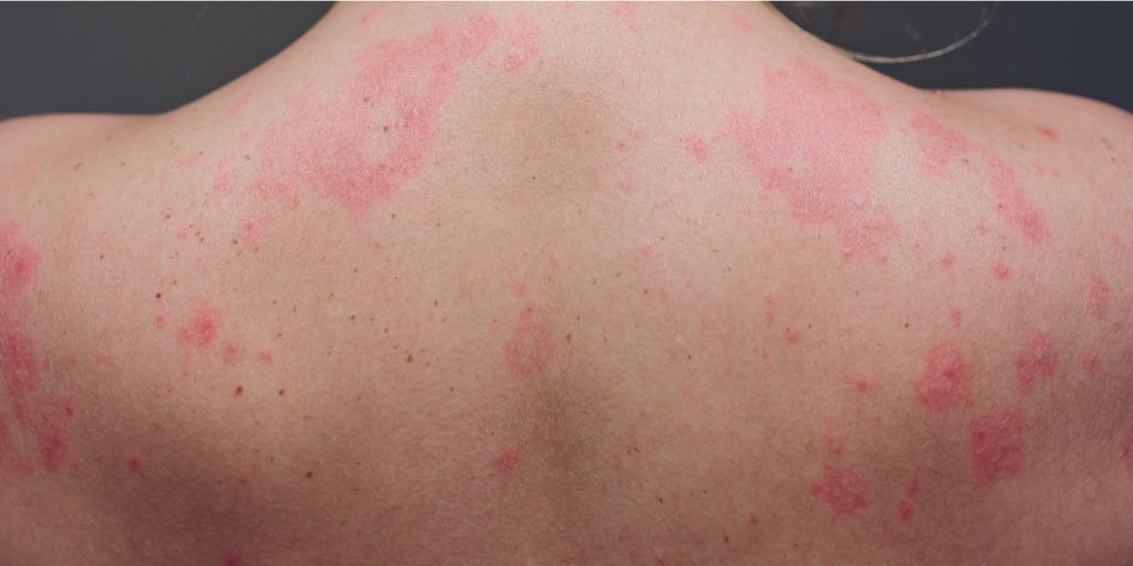 Algunas personas muestran síntomas de COVID-19 en forma de urticaria en la piel.