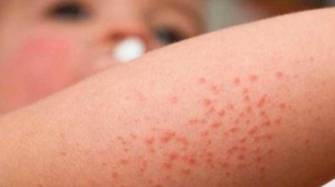 La dermatitis atópica es una de las enfermedades de la piel más común en niños / Edición Médica 