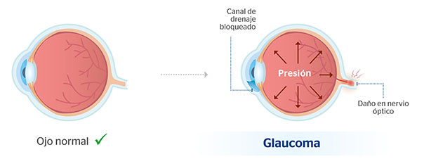Diferencias entre un ojo normal y uno con glaucoma/Clínica Baviera