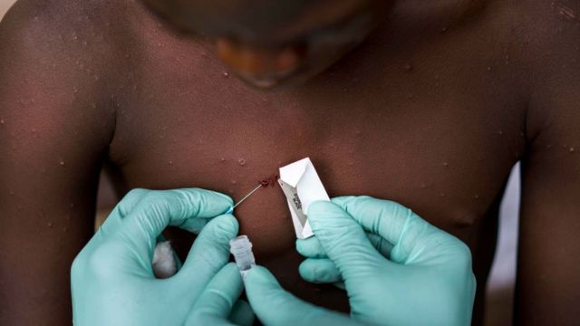 Aparece la vacuna contra la viruela del mono
