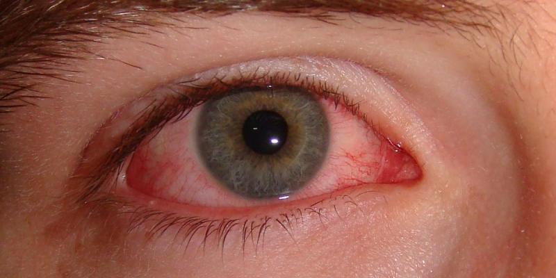 Conjuntivitis