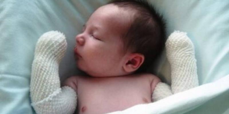 Un bebé nacido con piel de Mariposa. Foto de ONG Debra Piel de Mariposa