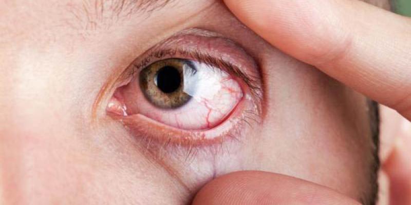 Síndrome / OnSalus El Síndrome de Sjogren afecta a miles de personas en nuestro país