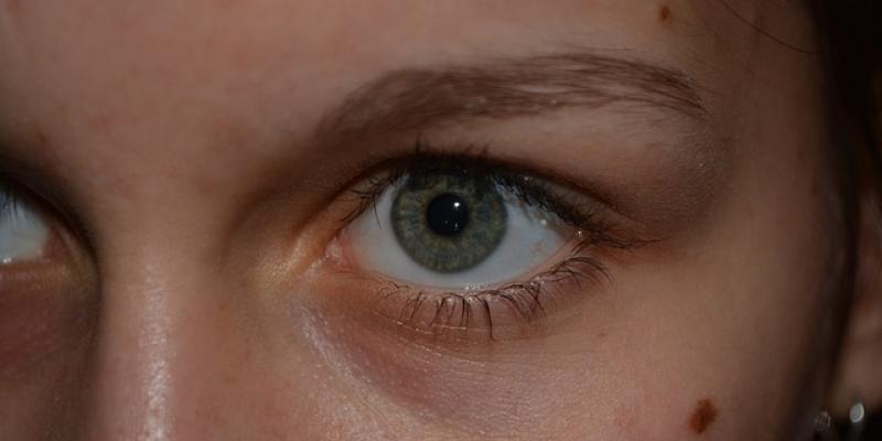 Signos y síntomas del cáncer de piel tipo melanoma / Foto de Pixabay Lunares en la cara de una joven. Foto de Pixabay