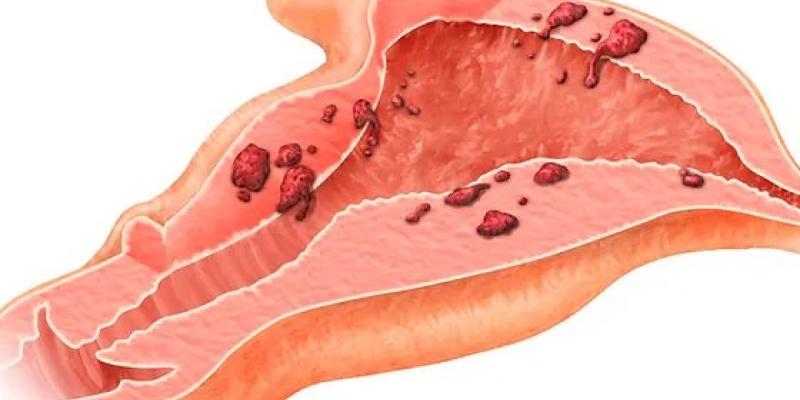 Adenomiosis / Pixabay Adenomiosis