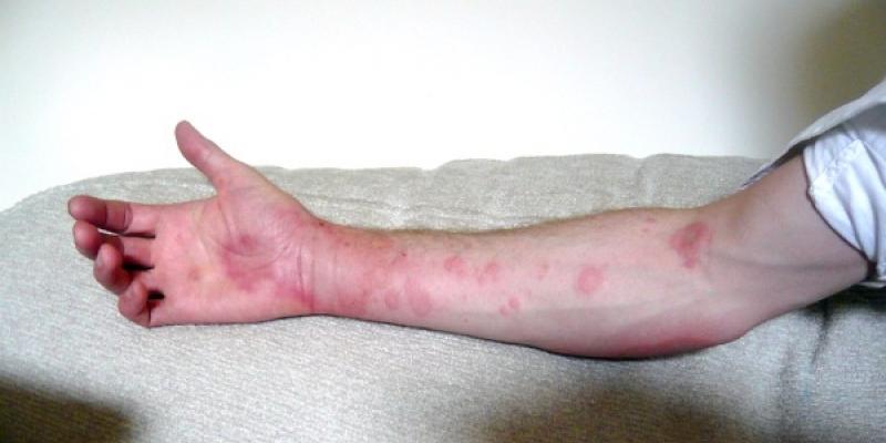 Alergia al frío/ Andy Carter Ejemplo de alergia al frío