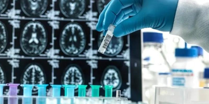 Imagen de una prueba médica/EstamosAqui Éxito en el fármaco contra el Alzheimer: Lecanemab