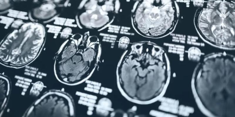 Alzheimer / Pixabay Radiografía del cerebro
