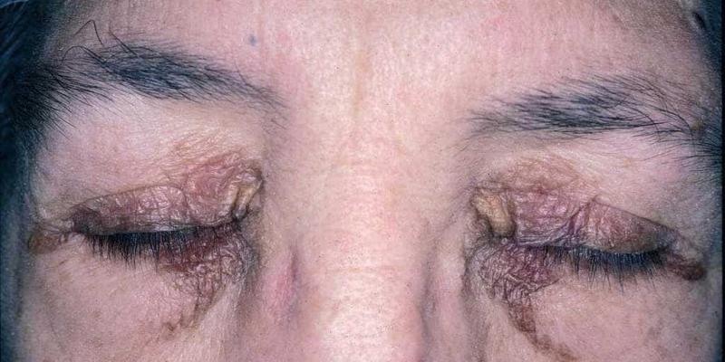 Imagen de una persona con amiloidosis/Actas-Dermo-Sifiliográficas Amiloidosis sistémicas