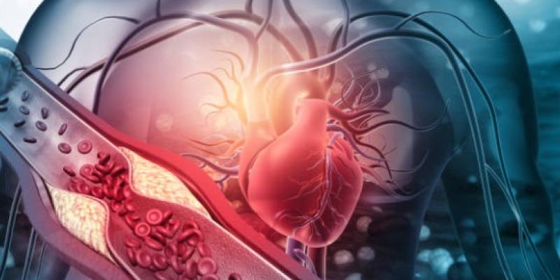 La arteriosclerosis en nuestras venas