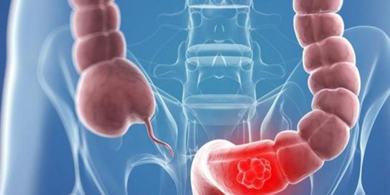 El cribado mediante prueba de heces es la mejor prueba diagnóstica con carácter preventivo / Archivo Imagen del intestino con cáncer de colon
