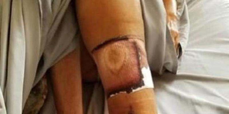 Una mujer se infectó por la bacteria carnívora en una playa de Florida y ha muerto. bacteria carnívora