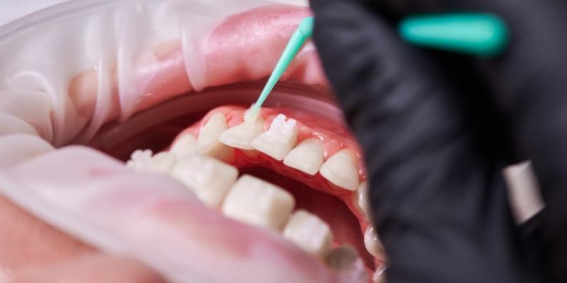 Gingivitis - Foto: Envato Elements Gingivitis
