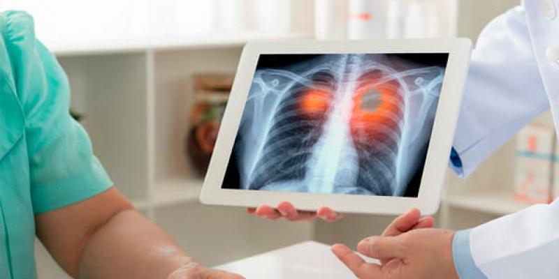Cáncer de pulmón / Gobierno de Euskadi El cáncer de pulmón ha causado 500 000 muertes en los últimos 30 años