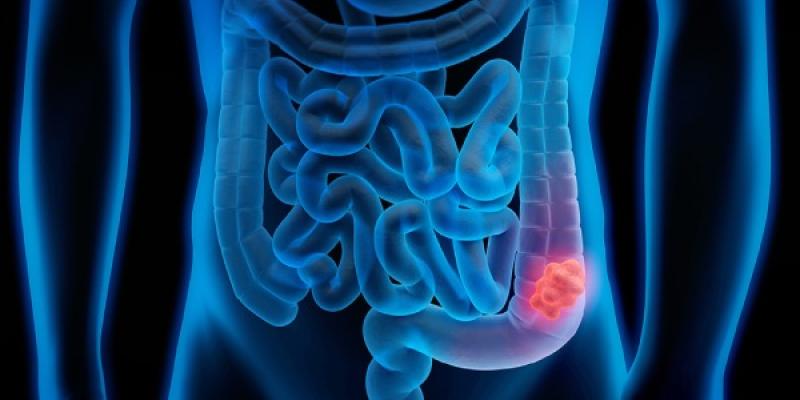 El cáncer con más afección para este 2023/ Medline Plus Cáncer colorrectal