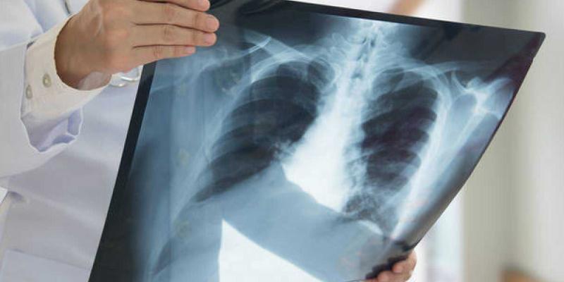 Imagen de una radiografía del pulmón/RTVE.es La inmunoterapia y la quimioterapia reducen los efectos del cáncer de pulmón
