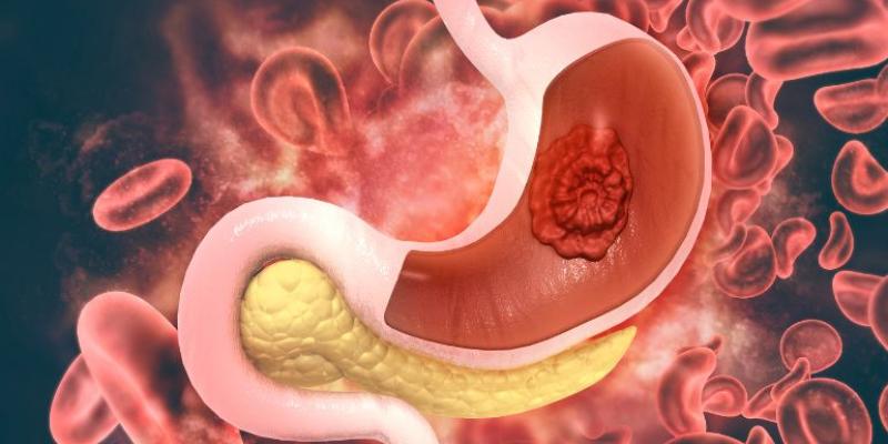 Imagen de un estómago La importancia del avance en la detección del cáncer gástrico