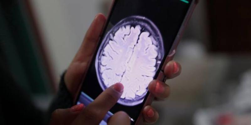Imagen de un cerebro/El Correo de Andalucía Un colorante ayuda a extirpar las células cancerígenas del cerebro