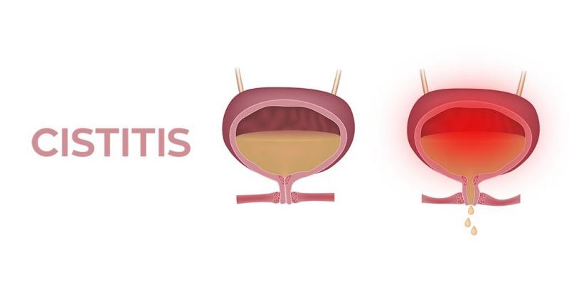 La molesta cistitis/BLOG vejiga con cistitis y vejiga sin la infección