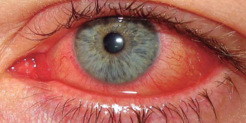 La conjuntivitis alérgica se produce por una reacción en la conjuntiva