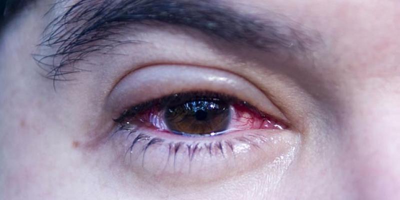 La conjuntivitis puede ser uno de los síntomas del COVID-19