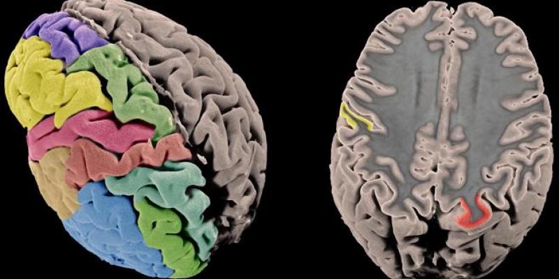 Foto: Ciber-ISCIII Imagen de la superficie cortical y el grosor del cerebro