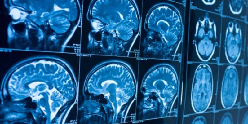 Secuelas neurológicas Covid Algunas personas con Covid-19 desarrollan síntomas neurológicos