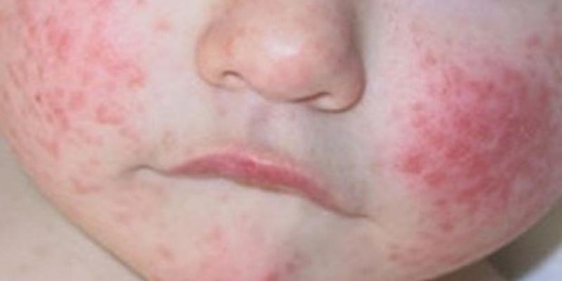 Dermatitis atópica Dermatitis atópica en los mofletes de un bebé