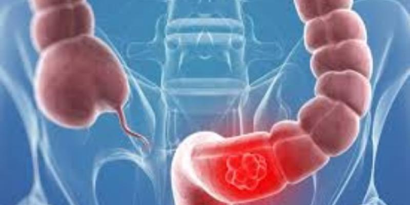 Bulos con el cáncer de colon Cáncer de colon