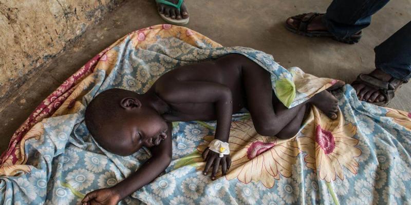 Imagen de un niño con desnutrición aguda/Acción Contra el Hambre La desnutrición aguda severa y la hambruna aumenta en los países menos desarrollados