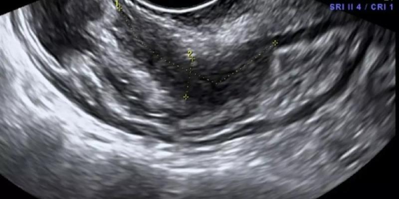 La endometriosis es una enfermedad benigna donde el tejido dentro del útero, que es el endometrio, sale fuera de la cavidad. / Fivclinic Endometrio tras una ecografía