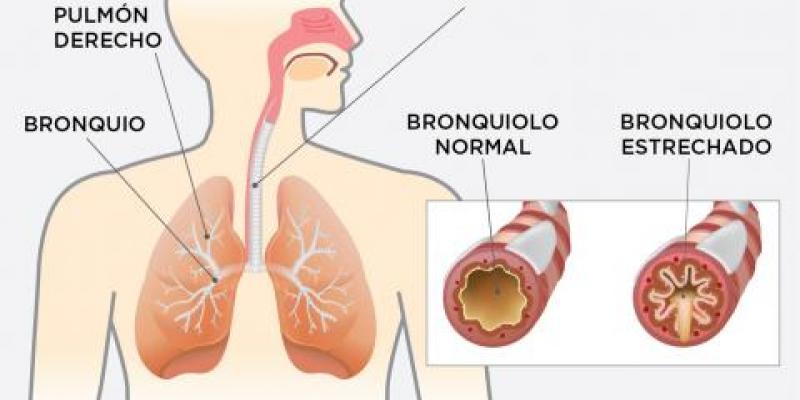 Ejemplo de pulmones con EPOC