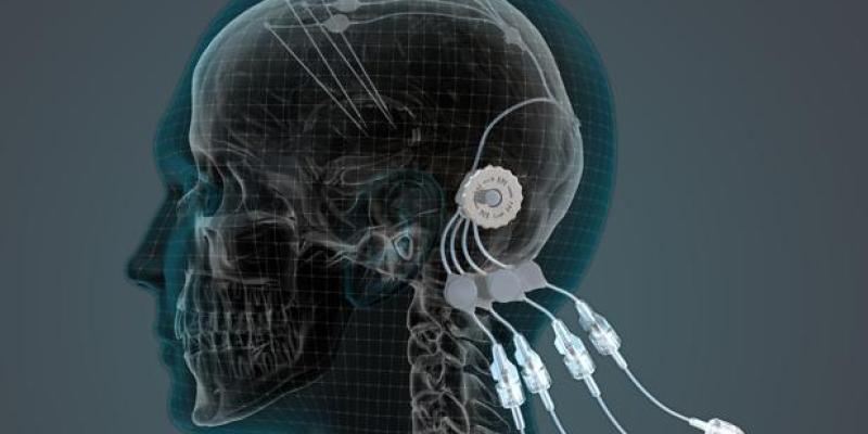 Así funciona la estimulación cerebral Ejemplo de estimulación cerebral profunda