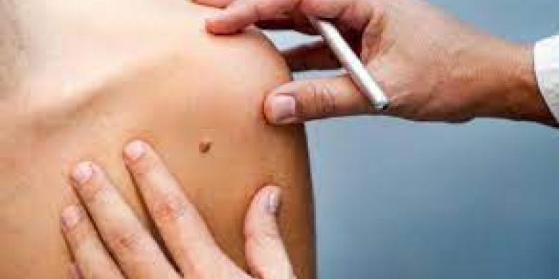 Este estudio podría ayudar a enfrentarse a los inicios de la metástasis del melanoma El melanoma es uno de los tumores más agresivos/Redacción médica