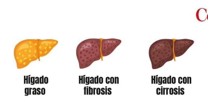 Hígado graso: evolución Conoce la enfermedad del hígado graso