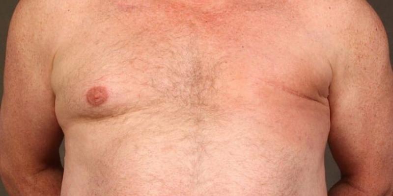 El cáncer de mama es más mortal en hombres. Un 80% de los casos de cáncer de mama en hombres se diagnostica en estado avanzado.