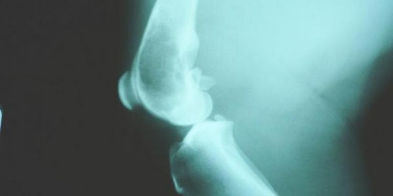 Es el cáncer de huesos más común en niños y la edad media de diagnóstico son los 15 años. Huesos