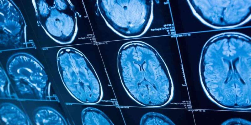 Esperanza y tratamientos para los enfermos de Huntington