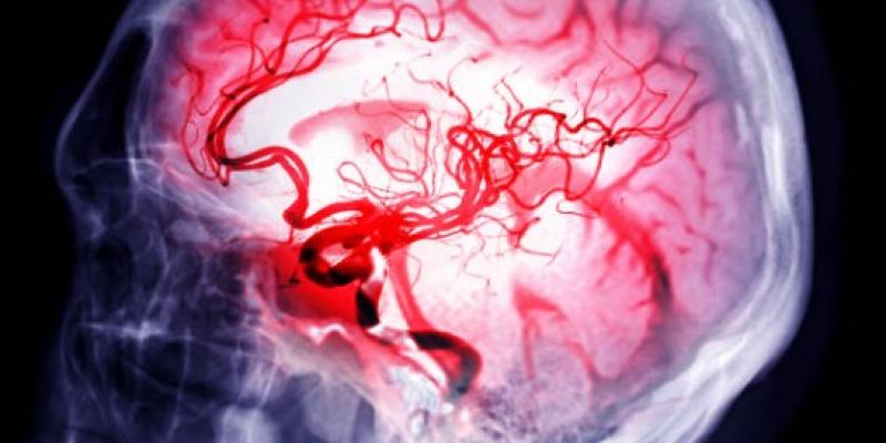 Los riesgos de sufrir un ictus - iStock El cerebro que sufre un ictus