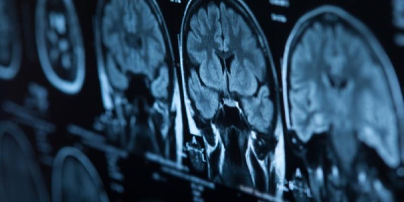 Una prueba neurológica después de un ictus | Foto de 123RF/merydolla Una prueba neurológica
