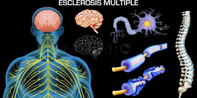 Infografía sobre la esclerosis múltiple 