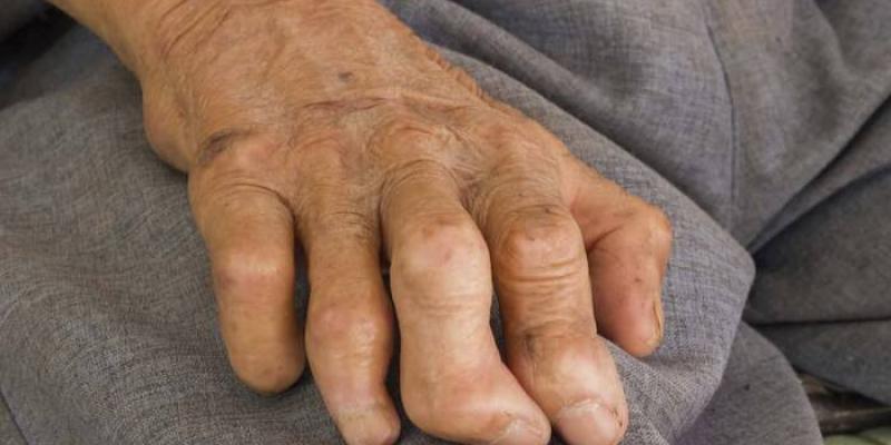 28 de enero, Día Mundial contra la Lepra El Día Mundial contra la Lepra 2021: Terminar con el estigma, la discriminación y el prejuicio